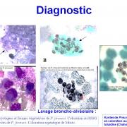 Pneumocystis et pneumocystose 5