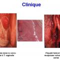 Trichomonas vaginalis et trichomonose (4)