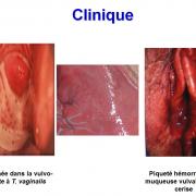 Trichomonas vaginalis et trichomonose (4)