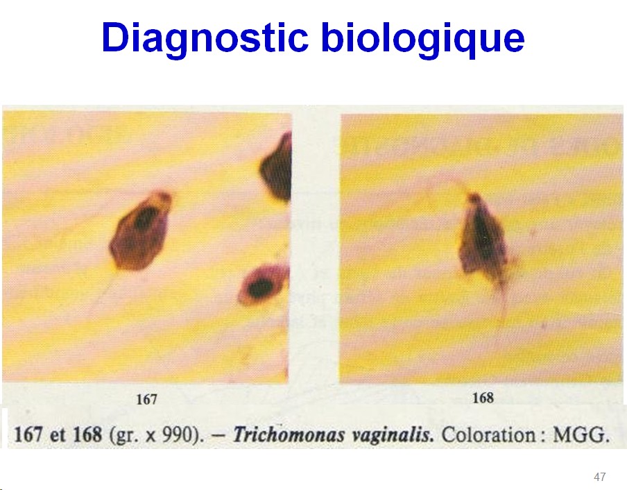 Trichomonas vaginalis et trichomonose (5)